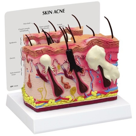 GPI ANATOMICAL Anatomical Model - Skin Acne - 2 Sided 3751